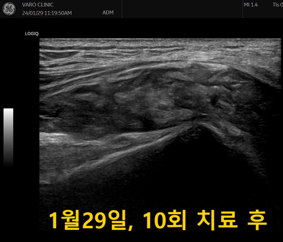 무릎 부위의 초음파 사진으로, 10회 치료 후의 모습을 나타냅니다.