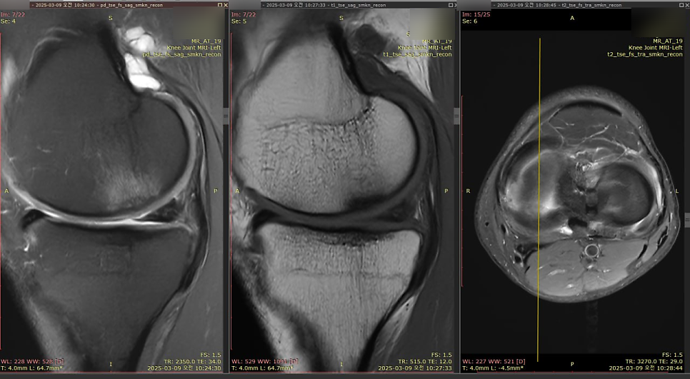왼쪽 무릎 관절의 시상면 및 축면 MRI 영상 세 장 — 서울 바로한의원 초음파 약침·도침