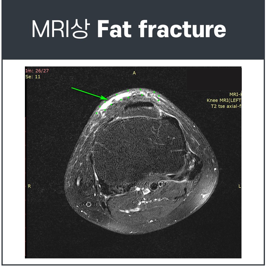 무릎 MRI 영상에서 슬개골 주변의 지방 골절을 가리키는 화살표