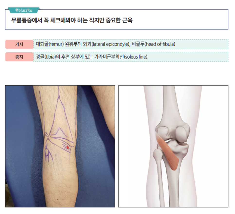 무릎 뒤쪽 슬와근의 해부학적 위치와 통증점을 표시한 다리 사진과 슬와근 해부도