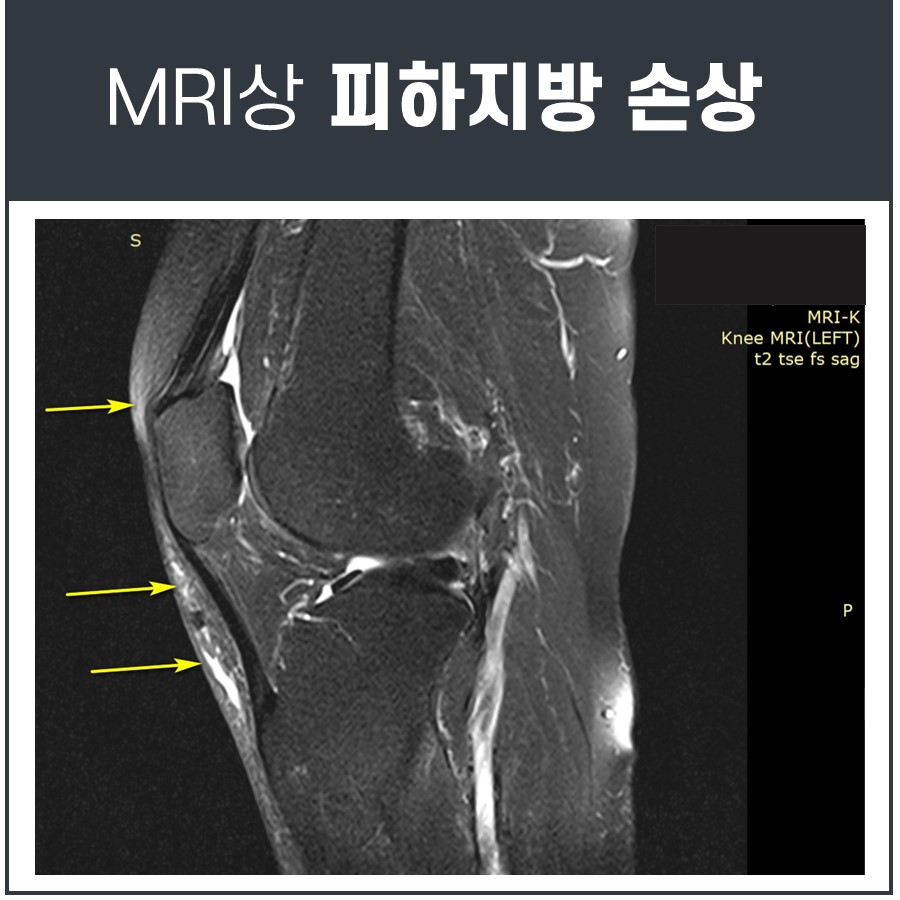 왼쪽 무릎 MRI 영상에서 피하지방 손상 부위를 노란색 화살표로 표시한 모습.