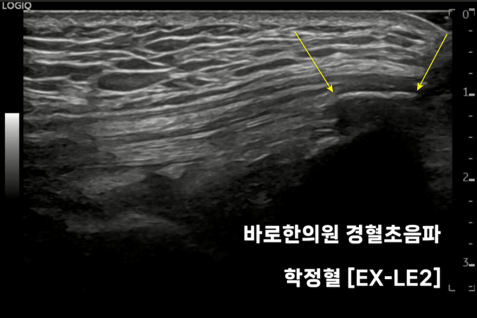 무릎 힘줄에 석회화가 보이는 초음파 사진