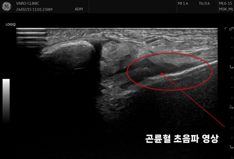 초음파 영상에서 곤륜혈 부위에 침이 삽입된 모습
