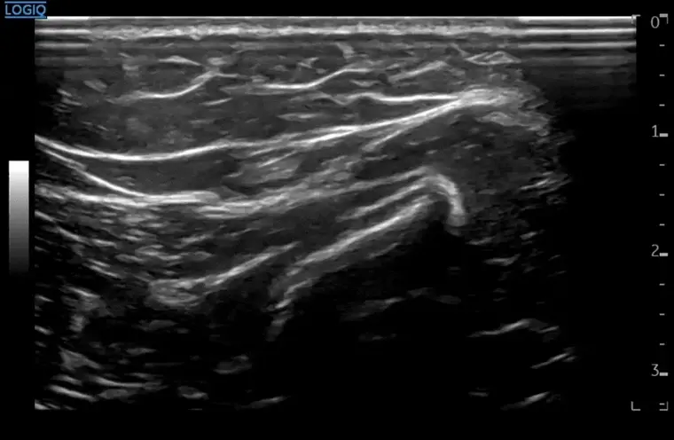 팔꿈치 바깥쪽 힘줄을 보여주는 초음파 영상 — 초음파 정밀 진단 | 서울 바로한의원 초음파 약침·도침·침도