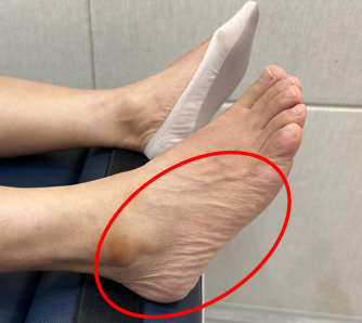 빨간색 원으로 표시된 발의 바깥쪽 복숭아뼈와 발 옆면