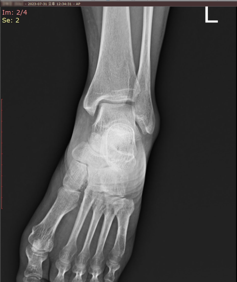 왼쪽 발과 발목의 사선 X-ray 사진