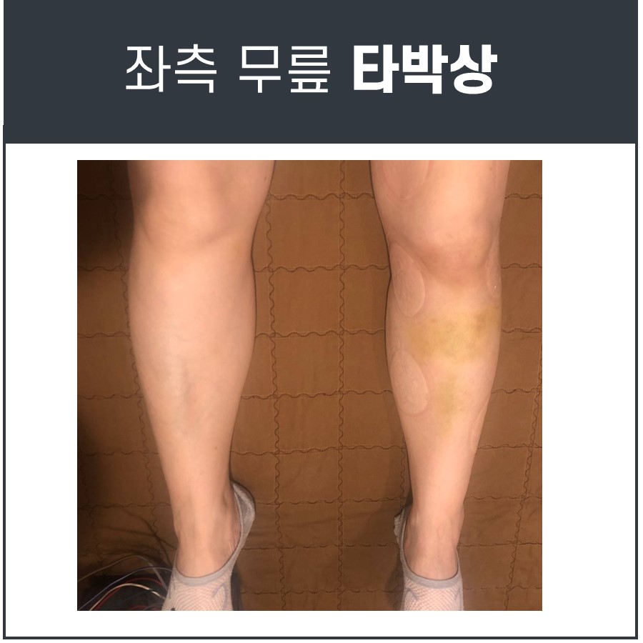 좌측 무릎 아래 정강이에 멍과 원형 자국이 있는 다리 모습