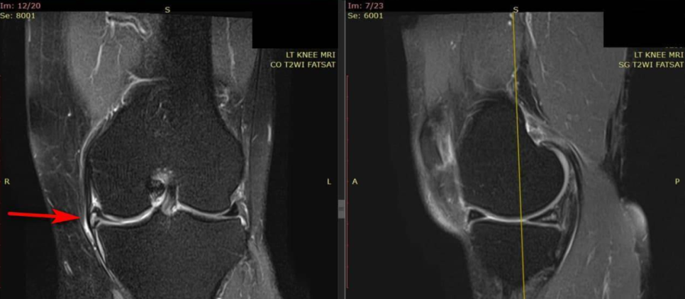 왼쪽 무릎 MRI 사진으로, 반월상 연골 부위에 빨간 화살표가 표시되어 있습니다.