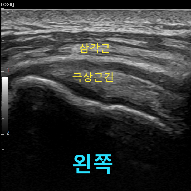 왼쪽 어깨의 삼각근과 극상근건을 나타내는 초음파 이미지