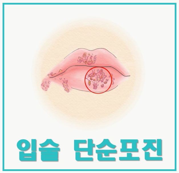 입술에 단순포진 증상이 나타난 그림 — 서울 바로한의원 초음파 약침·도침
