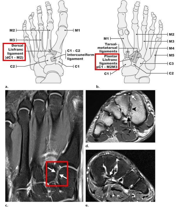 발의 리스프랑 인대 해부학적 구조를 나타내는 두 개의 도식과 세 개의 발 MRI 영상