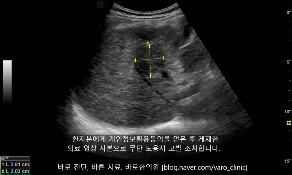 간 초음파 사진에서 측정된 병변이 보인다 — 초음파 정밀 진단 | 서울 바로한의원 초음파 약침·도침·침도