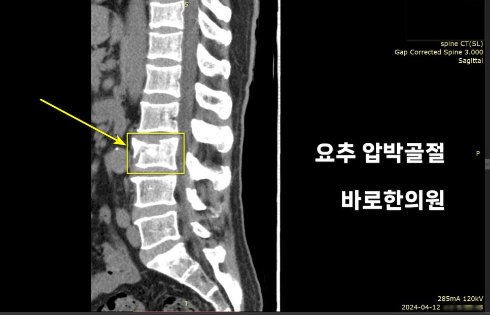 요추 CT 영상에서 압박 골절이 있는 척추뼈를 노란색 화살표와 사각형으로 표시한 모습