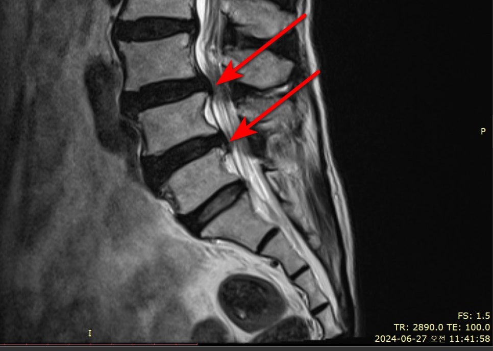 허리 MRI 사진에서 두 개의 척추 디스크가 돌출되어 있으며, 빨간색 화살표가 해당 부위를 표시하고 있다.