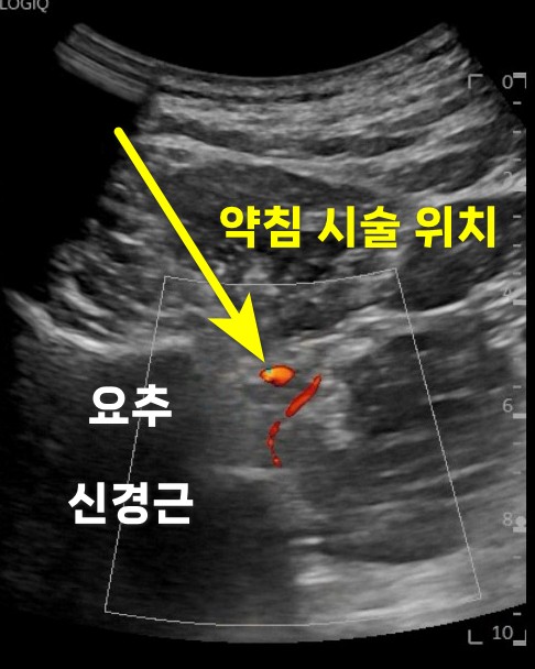 요추 신경근과 약침 시술 위치를 보여주는 초음파 이미지.