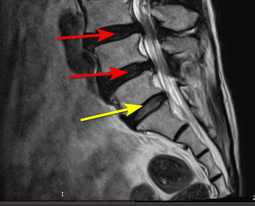 허리 MRI 사진에서 붉은색 화살표는 위쪽 두 개의 디스크 돌출을, 노란색 화살표는 아래쪽 디스크 돌출을 나타낸다.