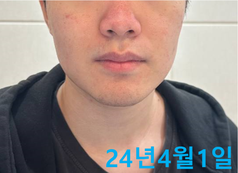 코와 볼에 붉은 기와 피부 요철이 있는 남성의 얼굴 사진. 24년 4월 1일 날짜가 표시되어 있다.