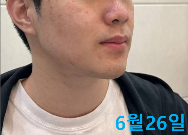 남성 얼굴의 측면으로, 뺨과 코 주변에 붉은 기와 피부 요철이 보이는 모습.