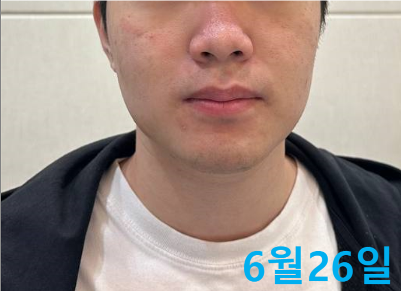 6월 26일 날짜가 표시된 남성의 얼굴과 목 부분으로, 뺨에 붉은 기와 피부 요철이 보인다.