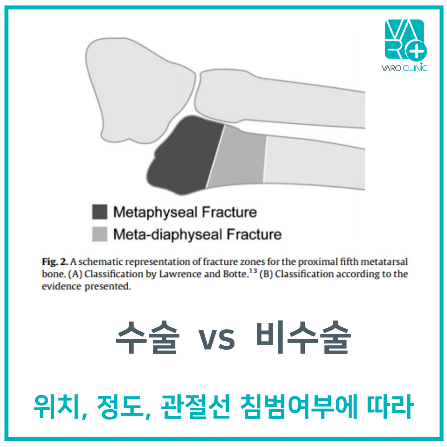 발등 뼈 골절 부위를 나타내는 도식으로, 골절 유형과 수술 여부 결정 기준에 대한 한국어 문구가 함께 표시되어 있습니다.