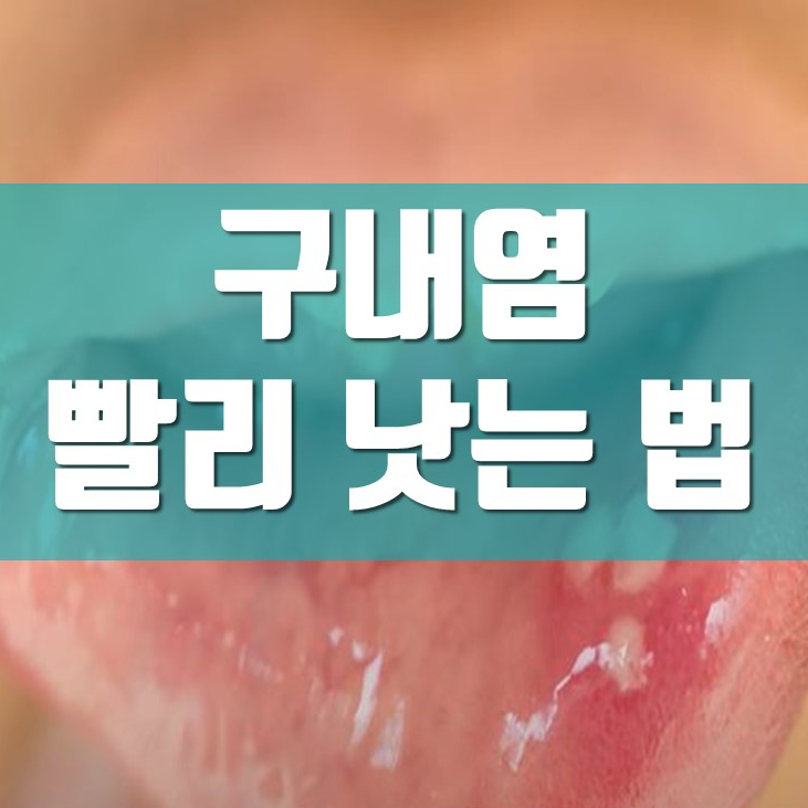 구내염 빨리 낫는 법, 한약 치료법 알려드립니다