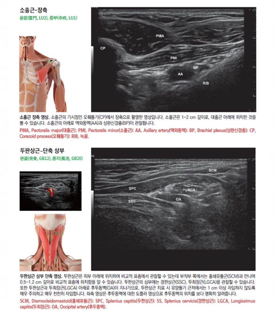 소흉근과 두판상근의 해부학적 그림 및 초음파 영상이 함께 제시된 의료 이미지 — 초음파 정밀 진단 | 서울 바로한의원 초음파 약침·도침·침도