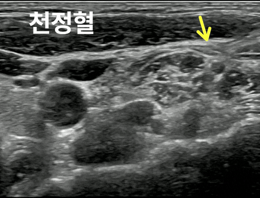 목 부위의 초음파 사진으로, 천정혈 부근의 조직과 노란색 화살표가 보인다.