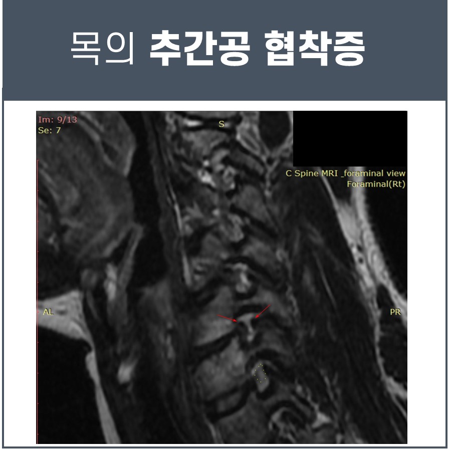 목 MRI 영상에서 추간공 협착증으로 좁아진 부위를 화살표로 표시한 모습