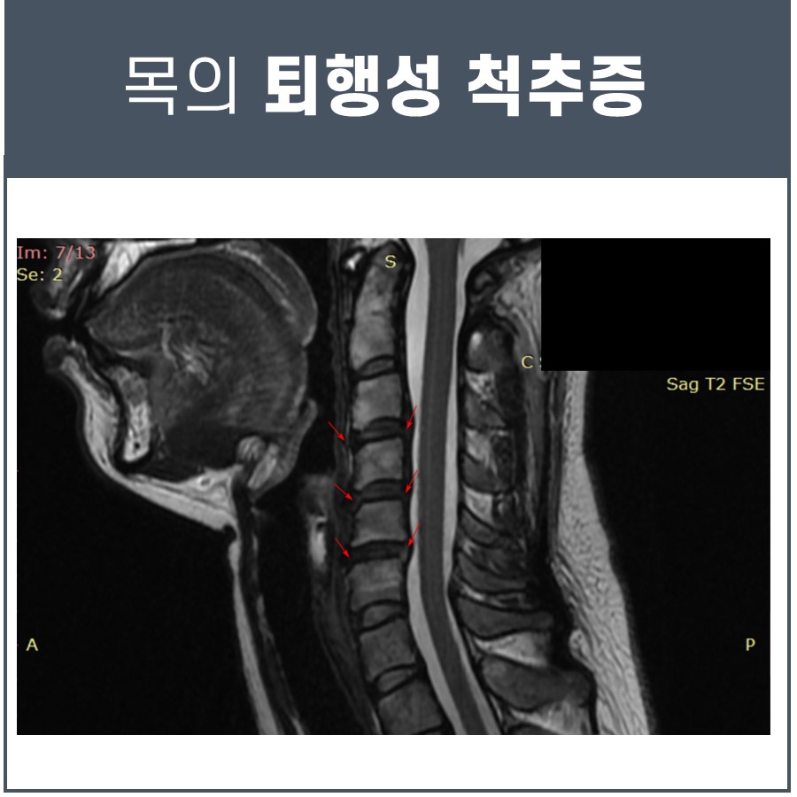 빨간 화살표로 퇴행성 변화가 표시된 목 부위의 MRI 영상