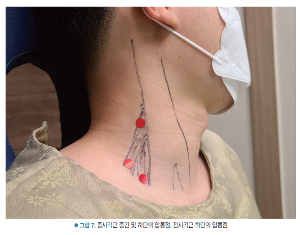 마스크를 착용한 사람의 목에 중사각근과 전사각근의 압통점을 표시한 모습