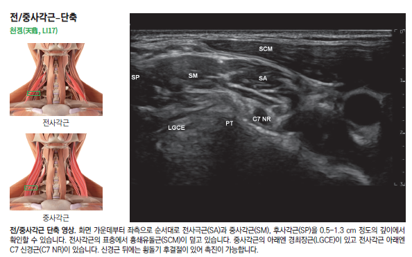 목 앞쪽과 중간 사각근의 해부학적 그림과 초음파 영상. 초음파 영상에는 사각근과 C7 신경근이 보인다.