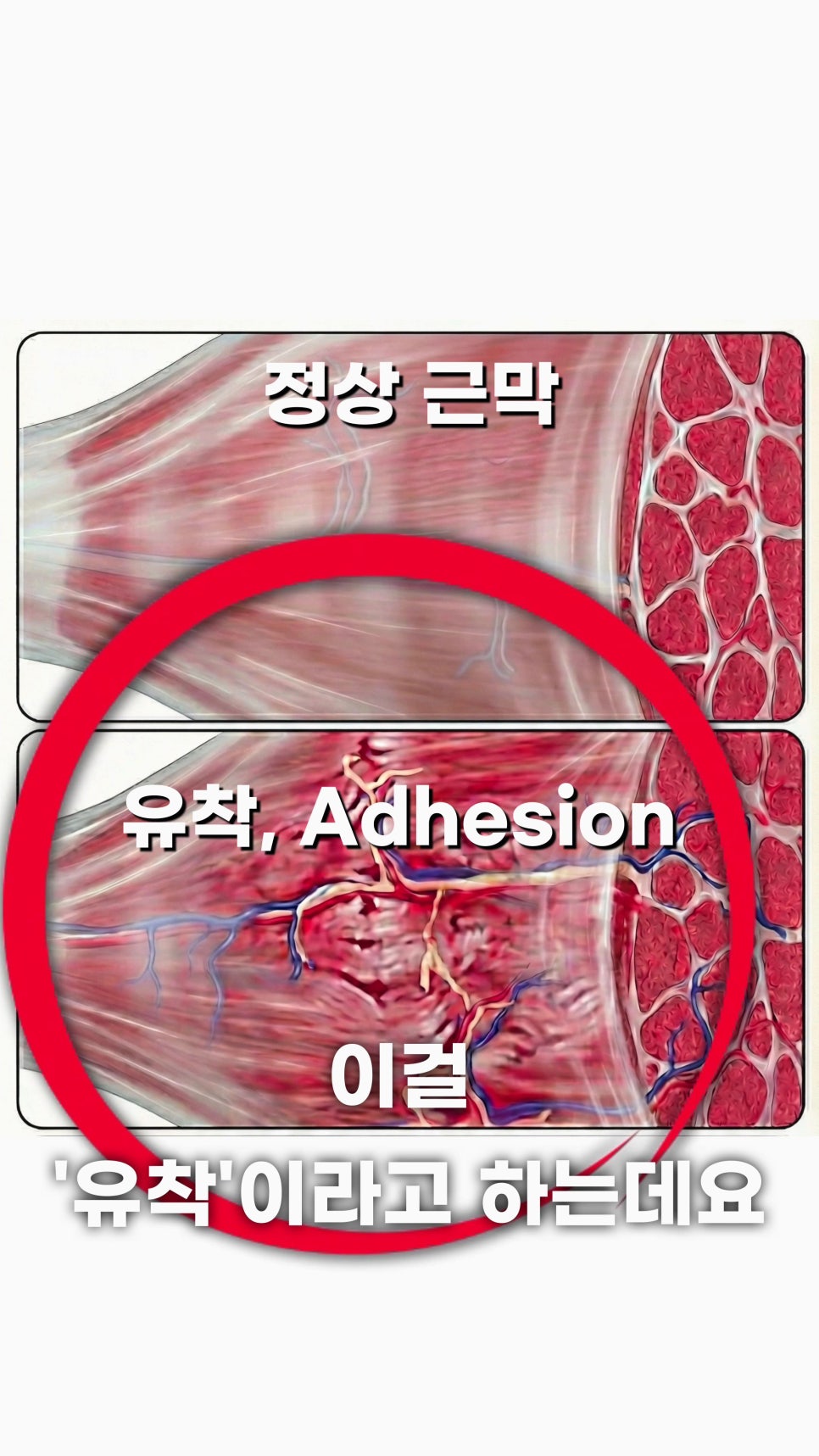 정상 근막과 유착된 근막의 모습을 비교하는 그림.
