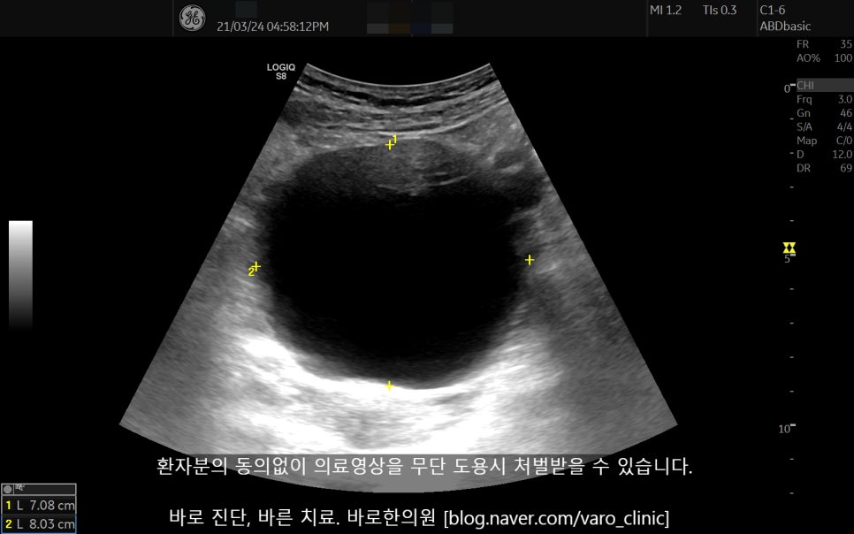 초음파 화면에 보이는 난소 낭종 이미지 — 초음파 정밀 진단 | 서울 바로한의원 초음파 약침·도침·침도