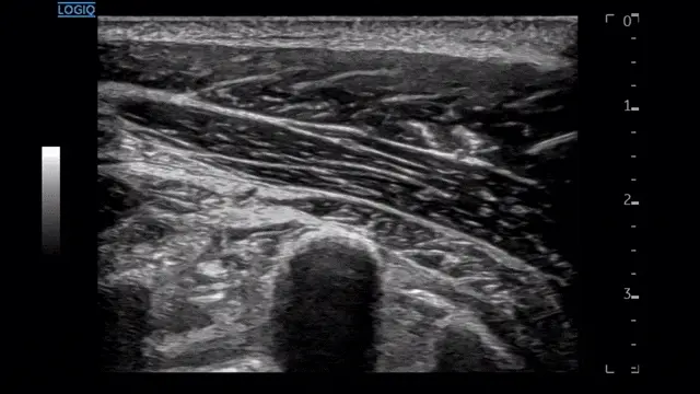 근육과 주변 조직을 보여주는 초음파 영상 — 초음파 정밀 진단 | 서울 바로한의원 초음파 약침·도침·침도