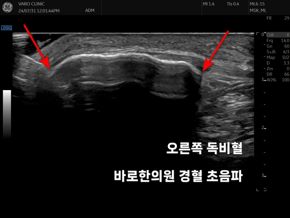 슬개골이 골절된 초음파 사진