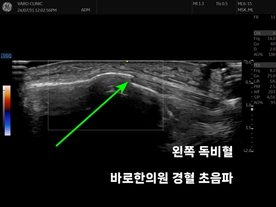 무릎 슬개건 부위를 초음파로 촬영한 사진이며, 녹색 화살표가 슬개건을 가리키고 있다.
