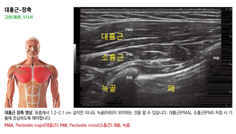 대흉근과 소흉근의 해부학적 위치를 보여주는 인체 모형과 대흉근, 소흉근, 늑골, 폐가 표시된 가슴 부위 초음파 영상.