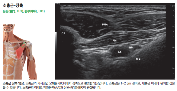 소흉근 해부학적 그림과 소흉근, 액와동맥, 상완신경총이 보이는 초음파 영상.