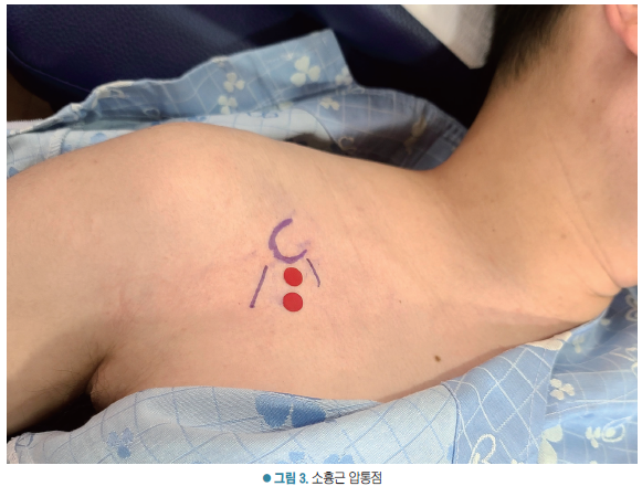 환자의 어깨와 가슴 부위에 소흉근 압통점을 표시한 모습