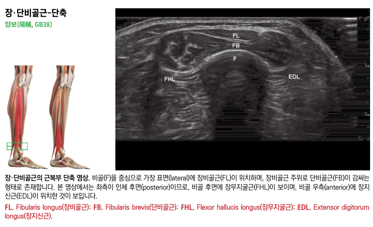 장비골근과 단비골근의 해부학적 그림과 해당 근육의 근복부 단축을 나타내는 초음파 영상 — 초음파 정밀 진단 | 서울 바로한의원 초음파 약침·도침·침도