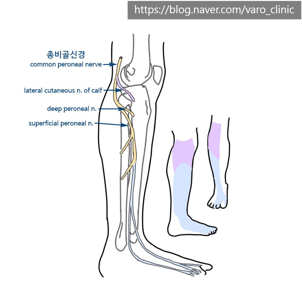 다리 비골신경과 그 가지들의 해부학적 구조 및 감각 지배 영역을 보여주는 그림