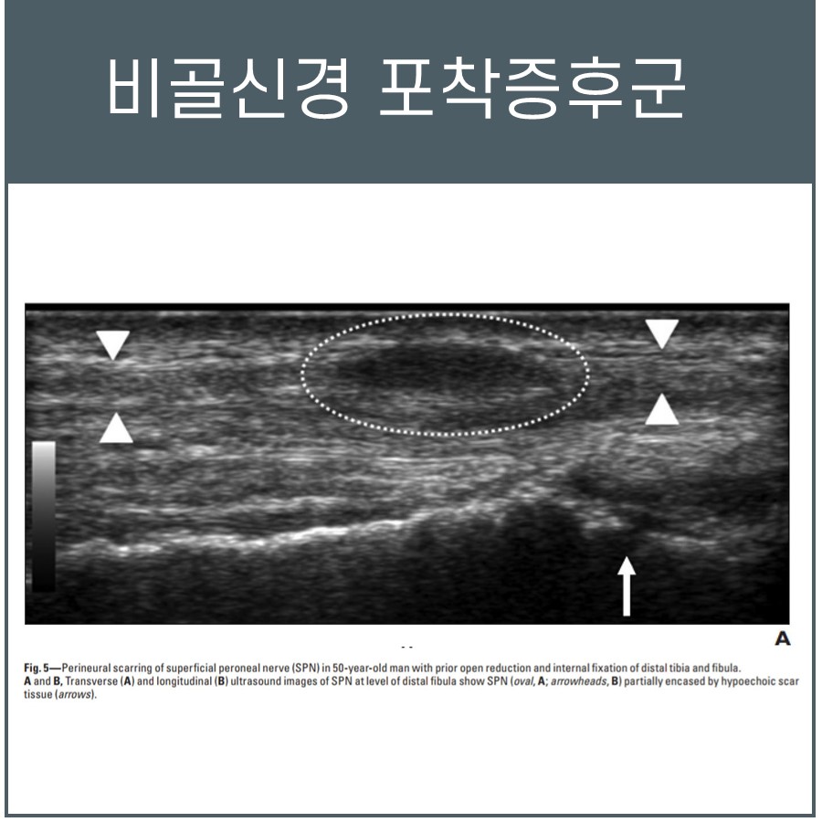 비골신경 포착증후군 초음파 사진으로, 비골신경과 흉터 조직이 나타나 있습니다.