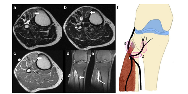 다리 MRI 영상 5개와 비골신경의 해부학적 위치를 나타내는 그림