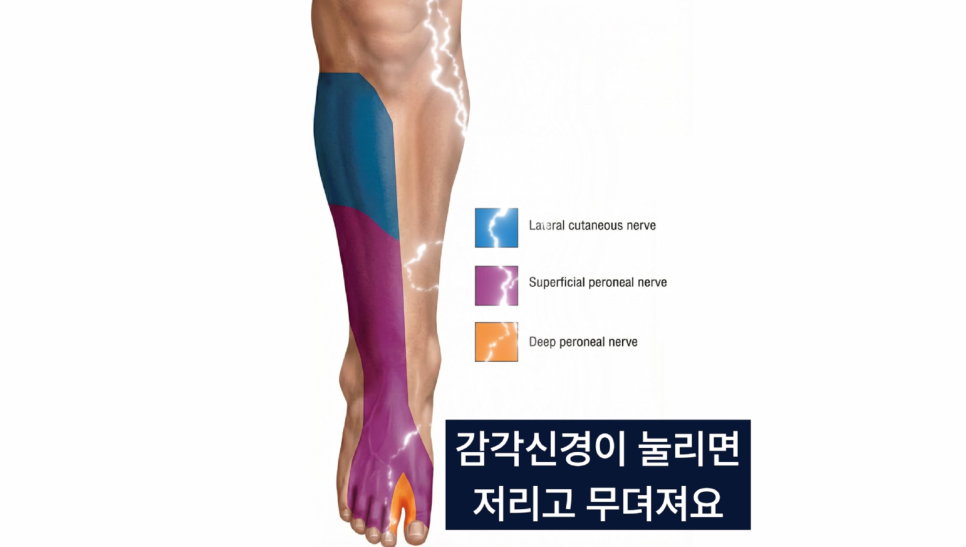 사람 다리와 발의 측면 피부 신경, 얕은 비골 신경, 깊은 비골 신경의 감각 분포 영역을 색깔로 표시한 그림. 감각 신경이 눌리면 저리고 무뎌진다는 한국어 문구가 함께 있습니다.