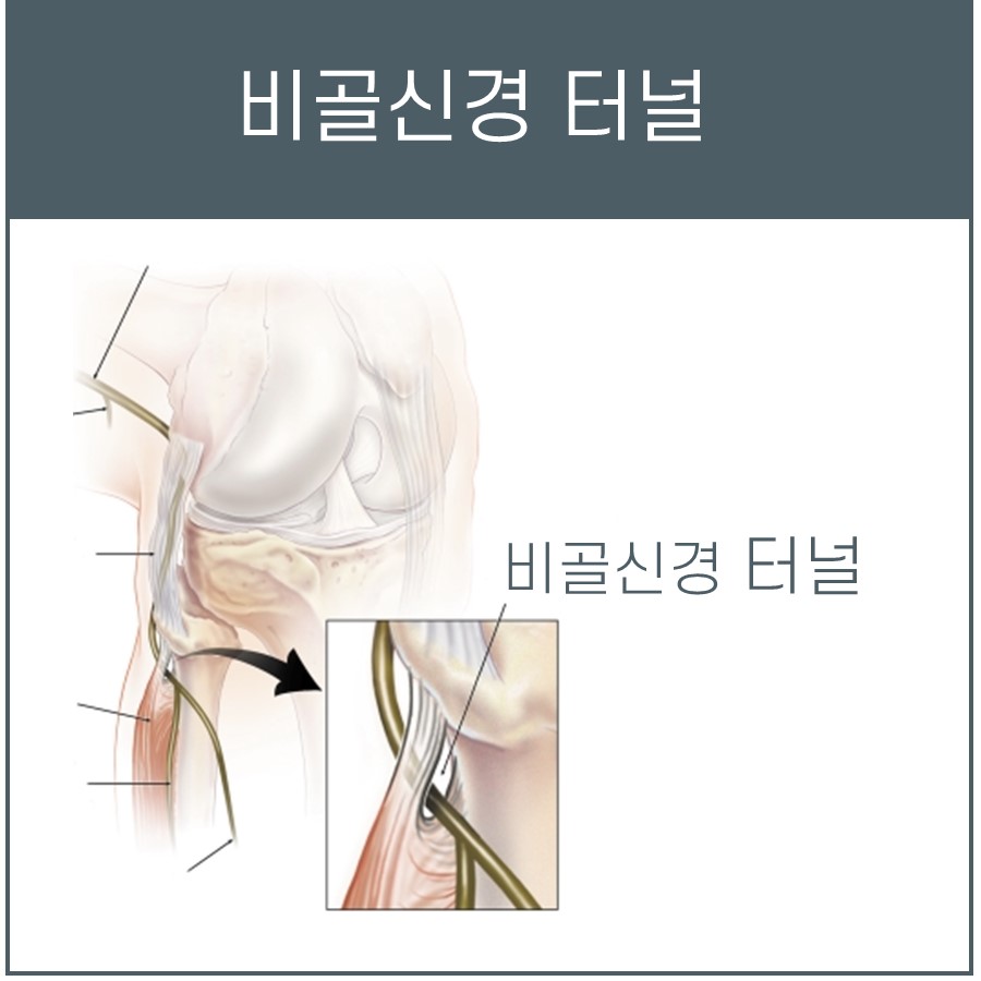 비골신경과 비골신경 터널의 해부학적 구조를 보여주는 그림