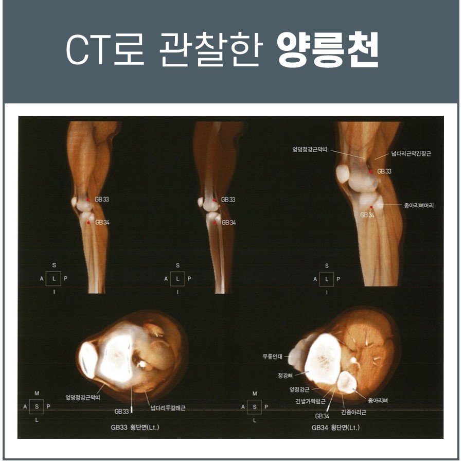 무릎과 종아리 부위의 CT 영상으로 양릉천(GB34) 혈자리를 표시한 모습