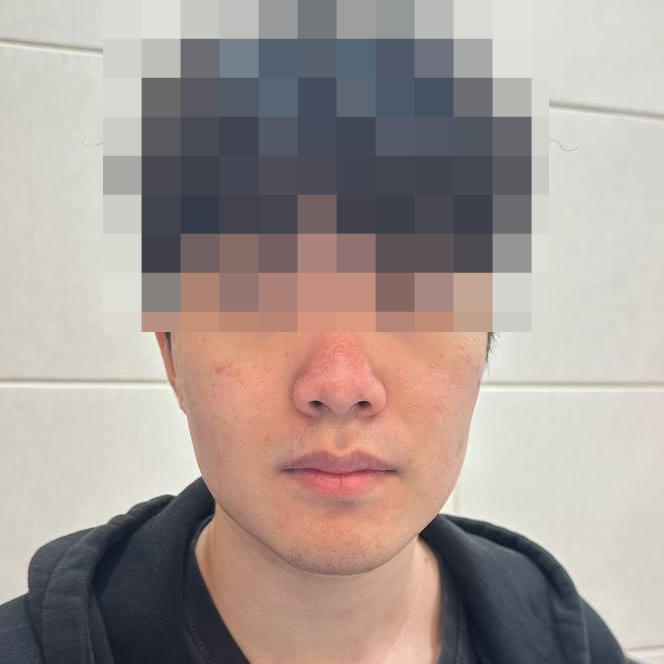 얼굴의 코와 볼 주변이 붉고 붉은 반점이 있는 사람의 모습