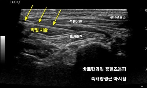 목 부위 근육에 약침 시술이 진행되는 초음파 영상