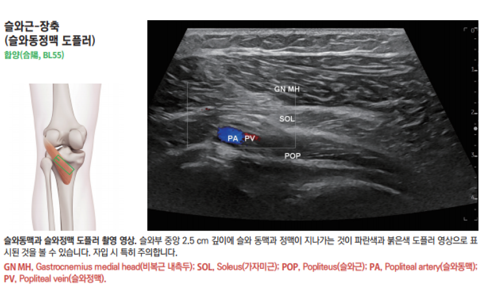 무릎 뒤쪽 슬와근의 해부학적 위치와 슬와 동정맥의 도플러 초음파 영상