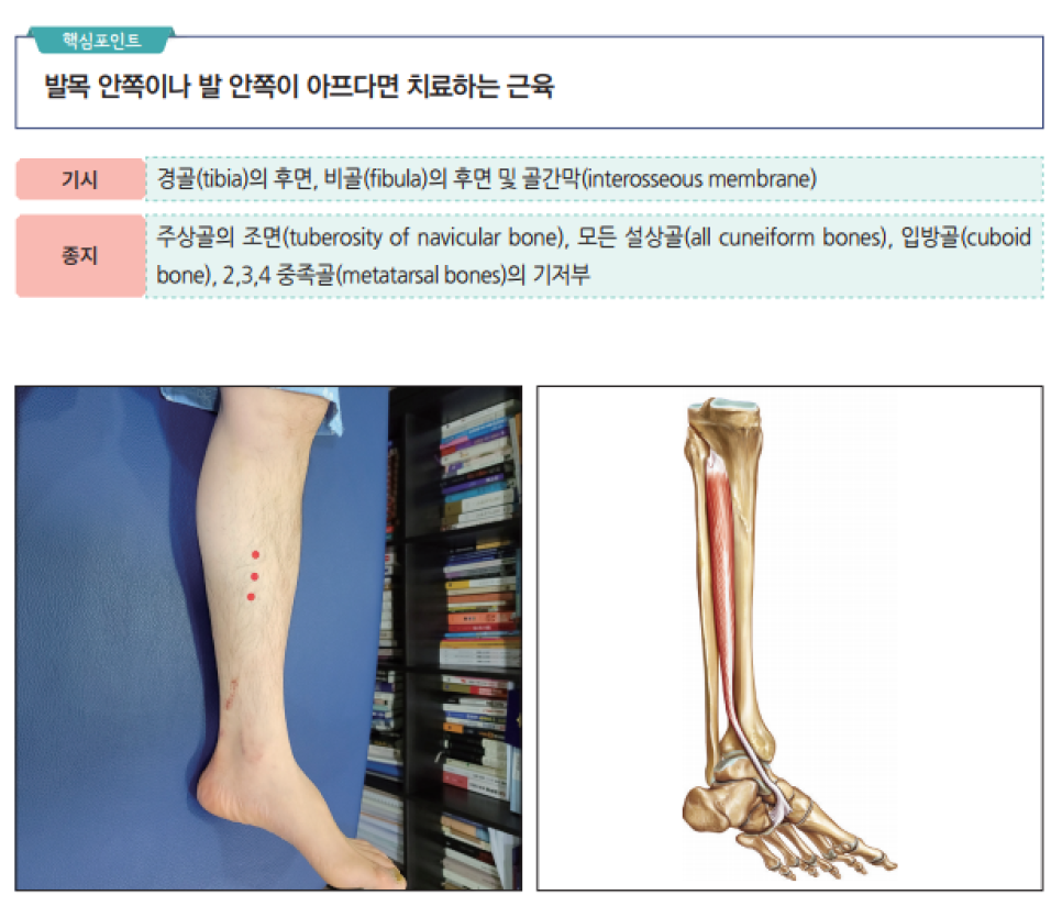 후경골근의 기시, 종지 정보와 함께 환자 다리에 표시된 치료점, 그리고 후경골근 해부학적 그림이 있는 이미지.